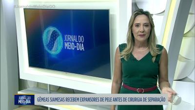 Gêmeas siamesas recebem expansores de pele antes de cirurgia de separação